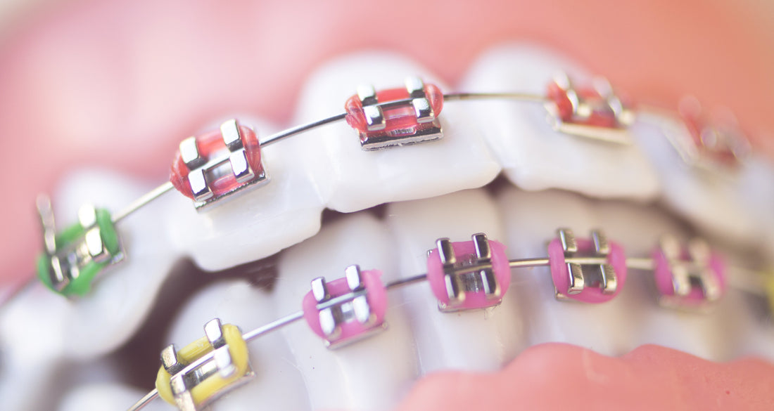 Cracking the Code: Benefits of Tooth Numbering on Orthodontic Bracket Bases
